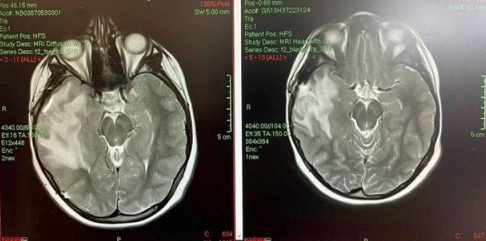 Olivia's brain scans showing inflammation